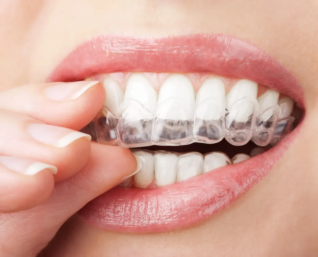 Invisalign Aberdeen